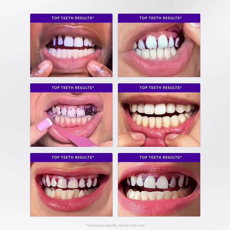 HiSmile® V34 Whitening Strips – Instant Radiance in 30 Minutes!