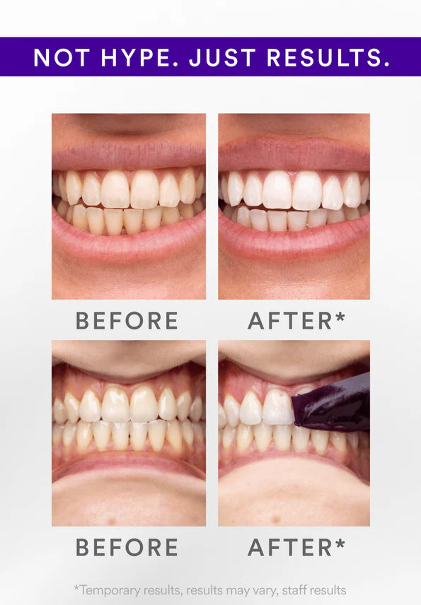 HiSmile® V34 Whitening Strips – Instant Radiance in 30 Minutes!